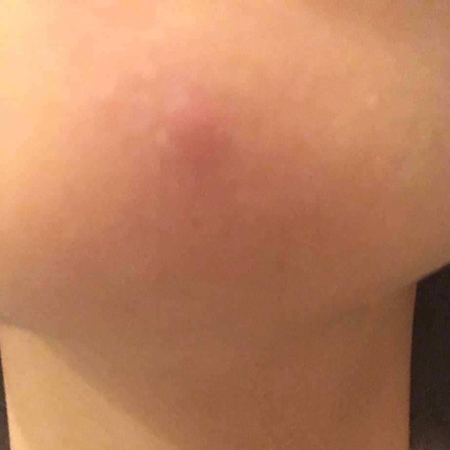 如何解決唔痛嘅石頭瘡 學術台 香港高登討論區