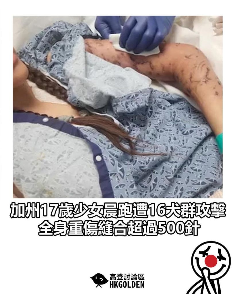 加州17歲少女晨跑遭16犬群攻擊　全身重傷縫合超過500針